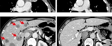 個(gè)性化免疫療法可用于治療轉(zhuǎn)移性乳腺癌